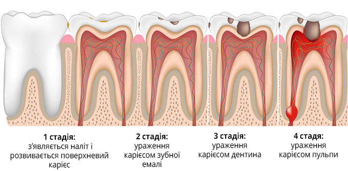 Лікування карієсу в Києві ціна