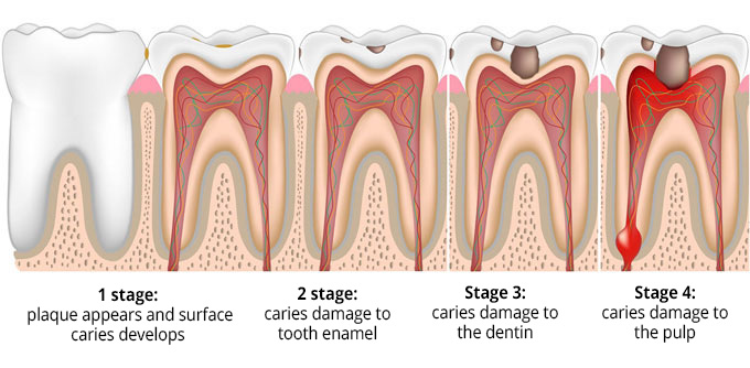 Price for tooth decay treatment in Kyiv
