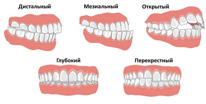 исправление прикуса зубов