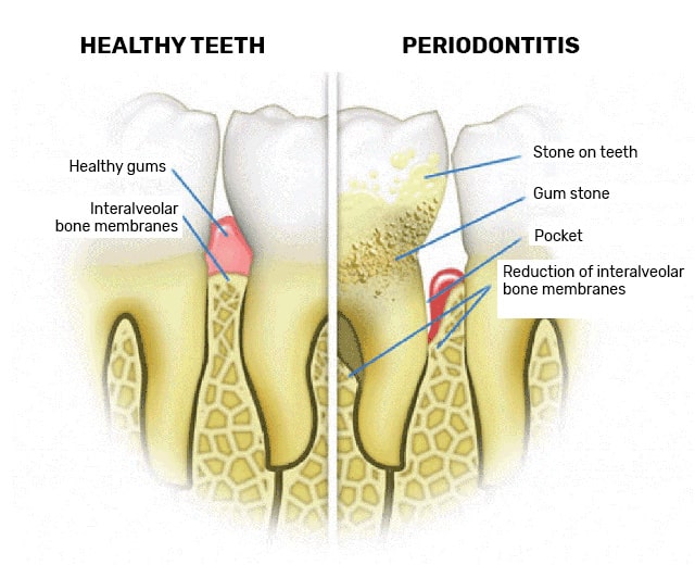Gum disease treatment at Eurodent, Kyiv 
