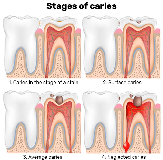 Stages of dental caries