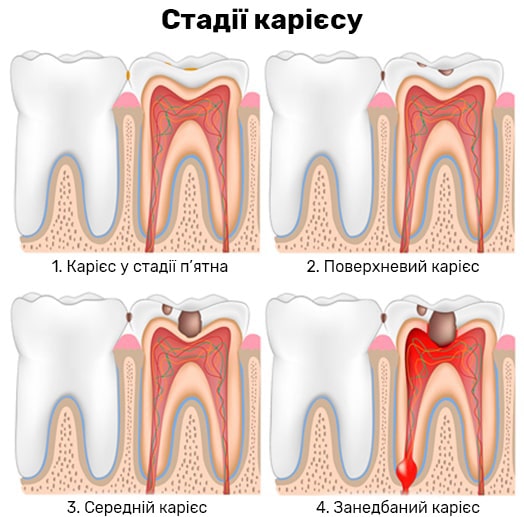 Стадії карієсу зубів