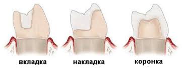 микропротезирование зубов