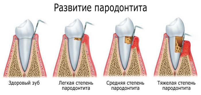 лечение пародонтита в Киеве в Евродент