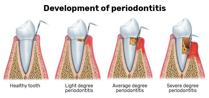 Periodontal treatment in Eurodent, Kyiv 
