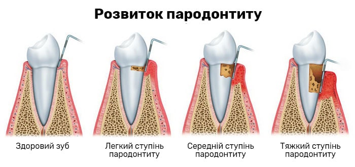 лікування пародонтиту в Києві в Євродент